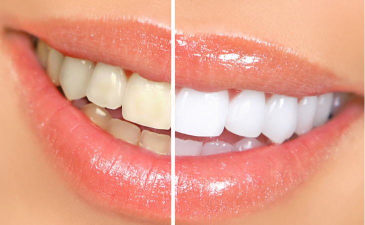 blanchiment des dents