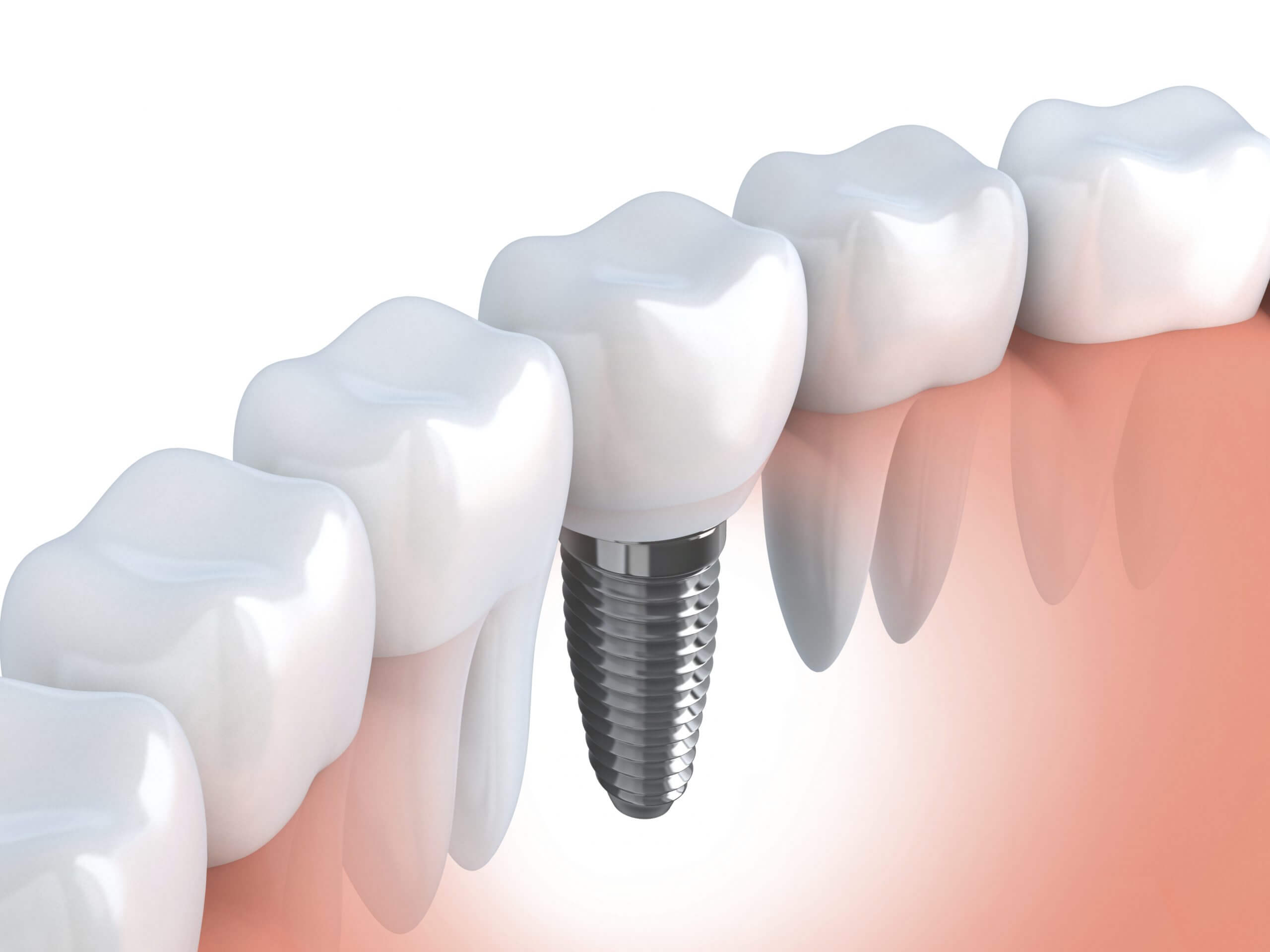 implant-dentaire