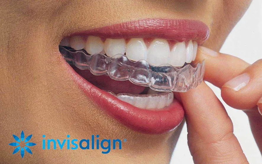 invisalign